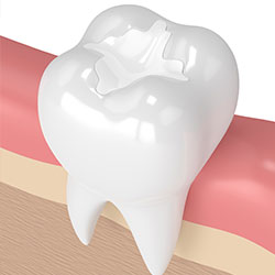 Animated image of a tooth