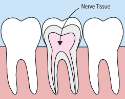 Depiction of a root canal