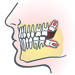 Illustration of wisdom teeth