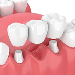 Example of a Dental Bridge on bottom jaw