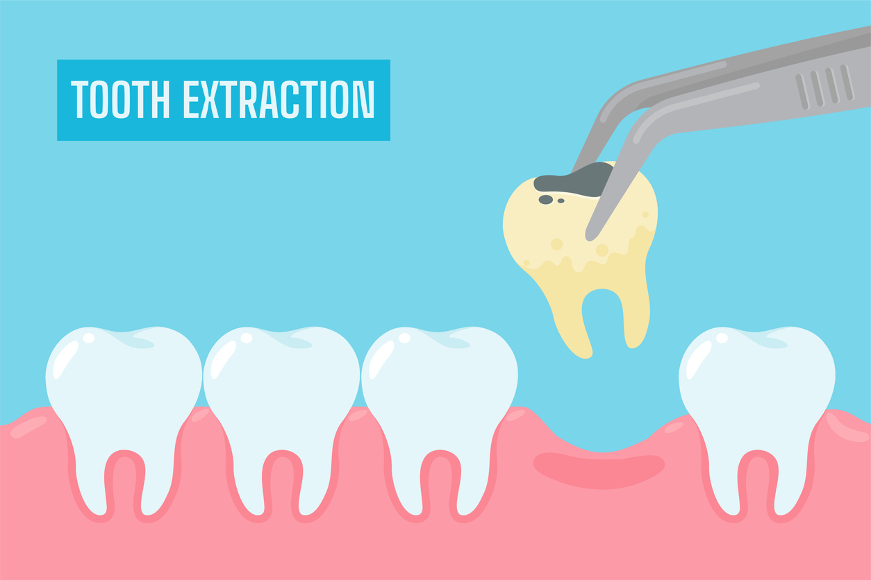Illustration of tooth extraction